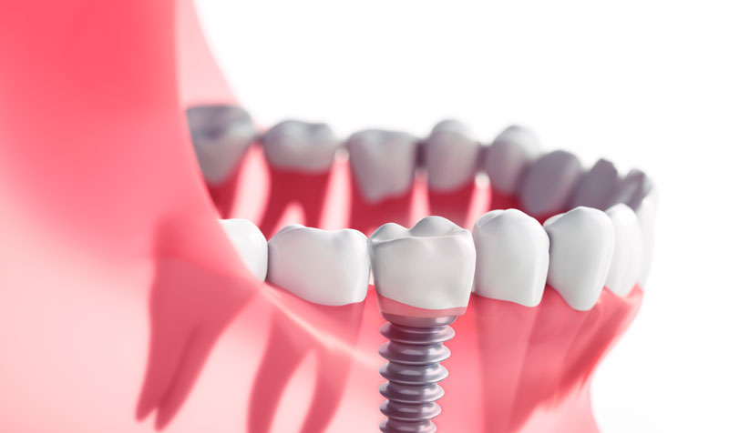 Unraveling the Complexities: Complications in Implant Dentistry