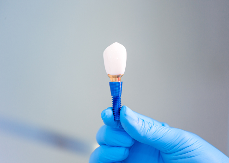 Understanding Abutment Implants: An In-Depth Guide to Dental Implants