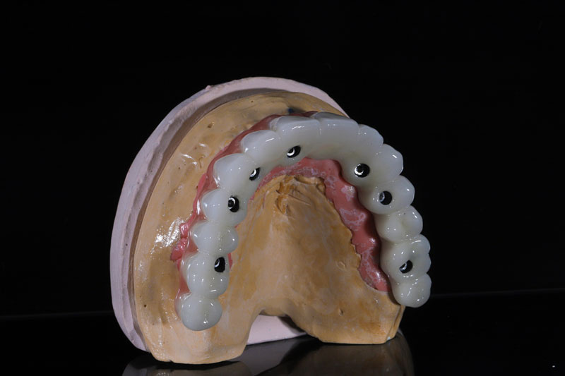 all on x dental implants with a full arch of teeth going across the implants