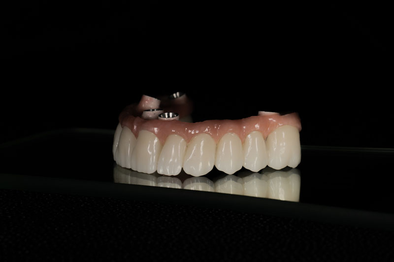 a full arch of teeth with holes for dental implants to be placed into the mouth