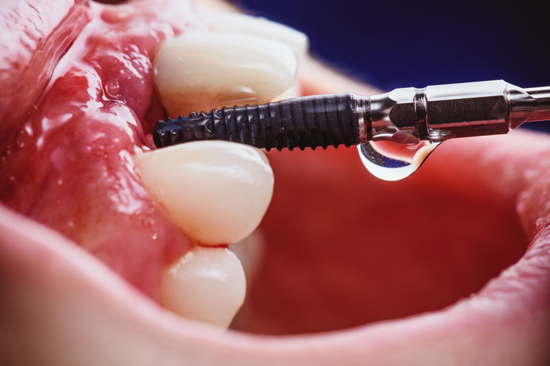 a single dental implant with a tool for placement onto the jaw